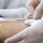 ketamine infusion therapy for trd-ptsd